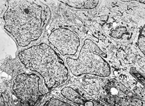 F,7y. | ependymoma F,7y. | ependymoma